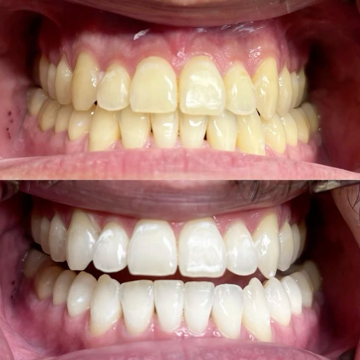 After smile makeover